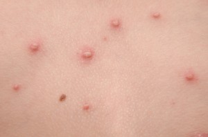 Insect Bites Or Chicken Pox - A Parent's Dilemma - deBugged